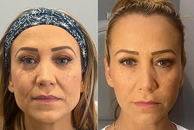 botox_before-after Sirius Med Spa Botox