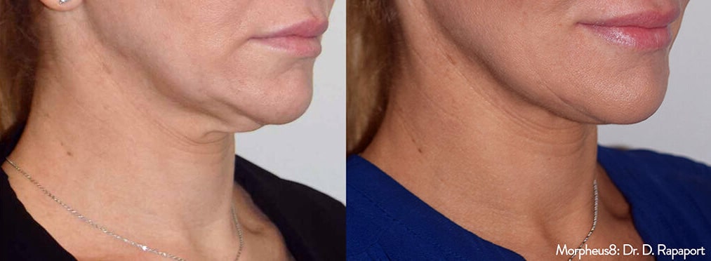 morpheus8-before-and-after_1 Sirius Med Spa Morpheus8 Microneedling