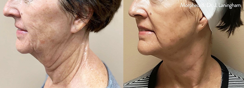 morpheus8-before-and-after_2 Sirius Med Spa Morpheus8 Microneedling