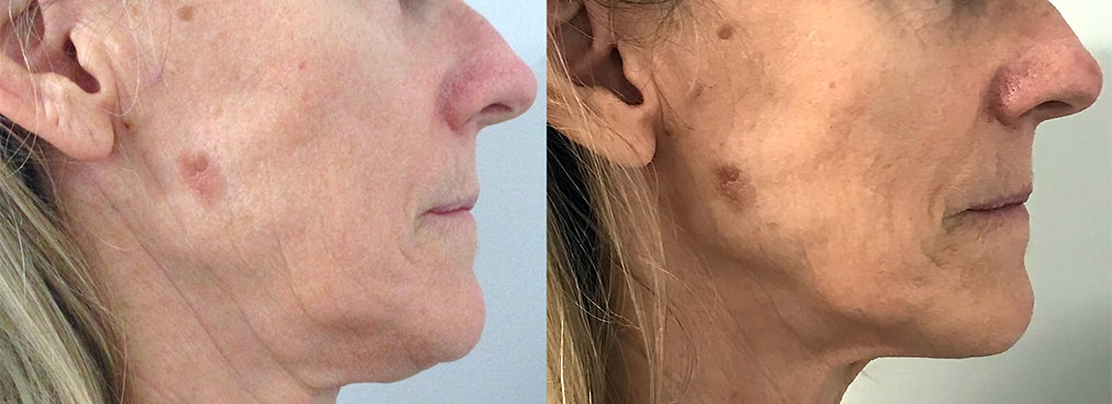 morpheus8-before-and-after_3 Sirius Med Spa Morpheus8 Microneedling