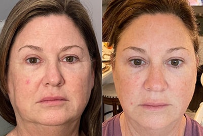 restylane_before-after Sirius Med Spa Restylane