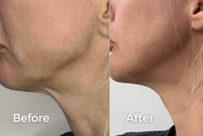 volux_before-after Sirius Med Spa volux