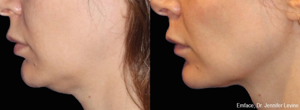 emface-before-and-after_1 Sirius Med Spa Morpheus8 Body Contouring