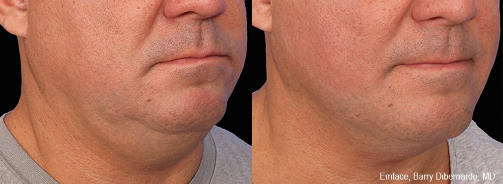 emface-before-and-after_2 Sirius Med Spa Morpheus8 Body Contouring
