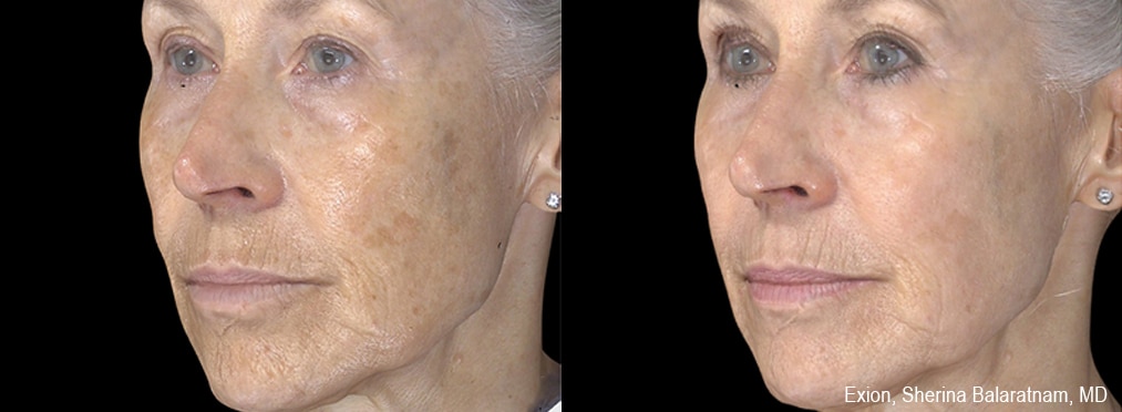 exion-before-and-after_1 Sirius Med Spa Morpheus8 Body Contouring