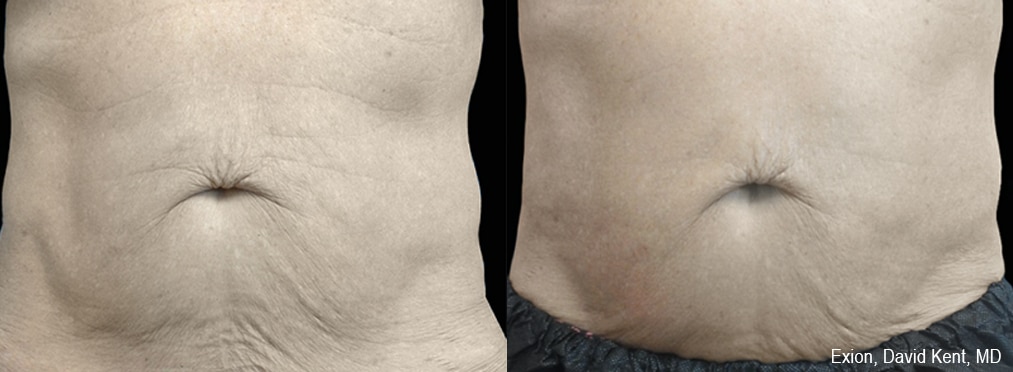 exion-before-and-after_2 Sirius Med Spa Morpheus8 Body Contouring