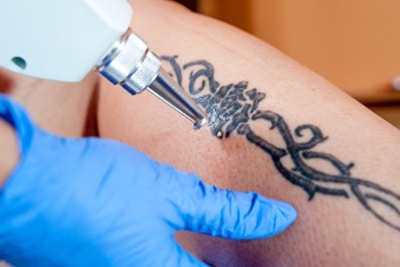 clearlaze-pico ClearLaze Tattoo Removal at Salora Med Spa