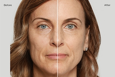 sculptra_before-after Sculptra at Salora Med Spa